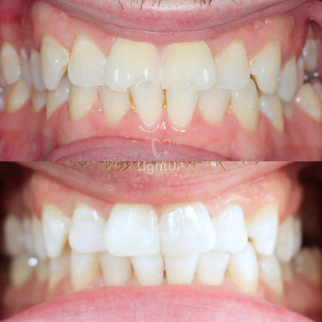 Teeth Whitening + Edge Bonding
(two teeth) — before and after