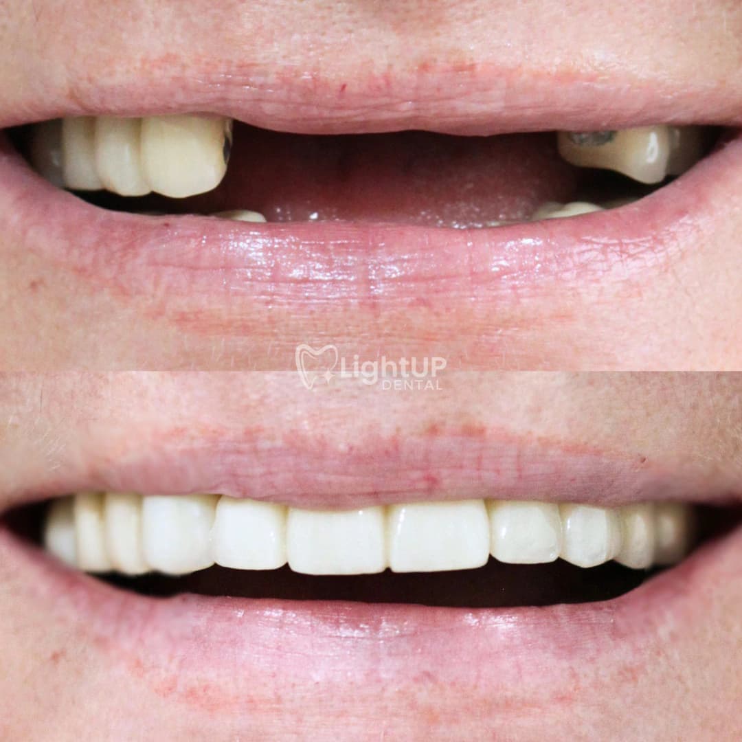 Dental Implant Bridge — before and after