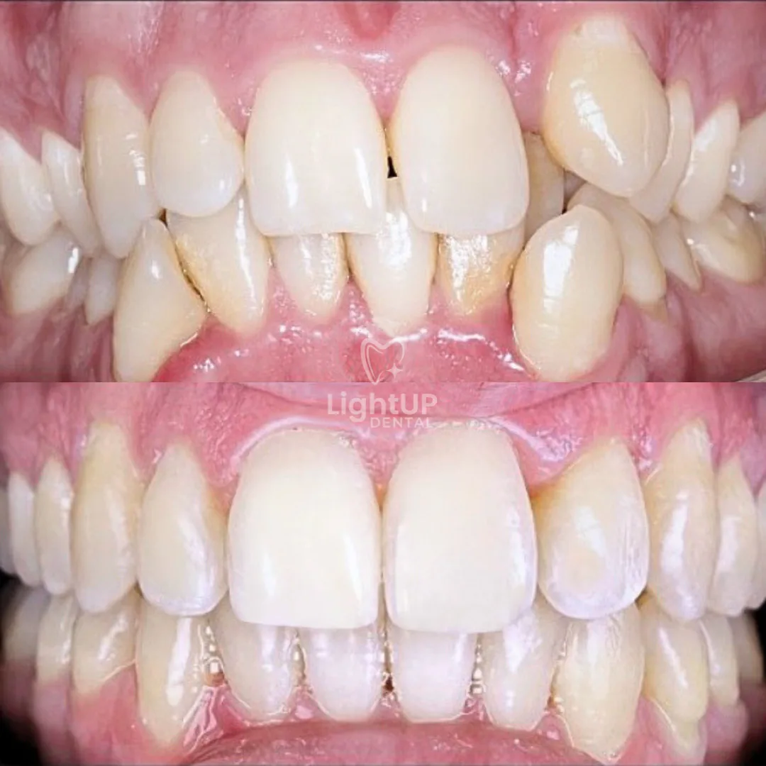 Hybrid Orthodontics (Braces + Clear Aligners) — before and after