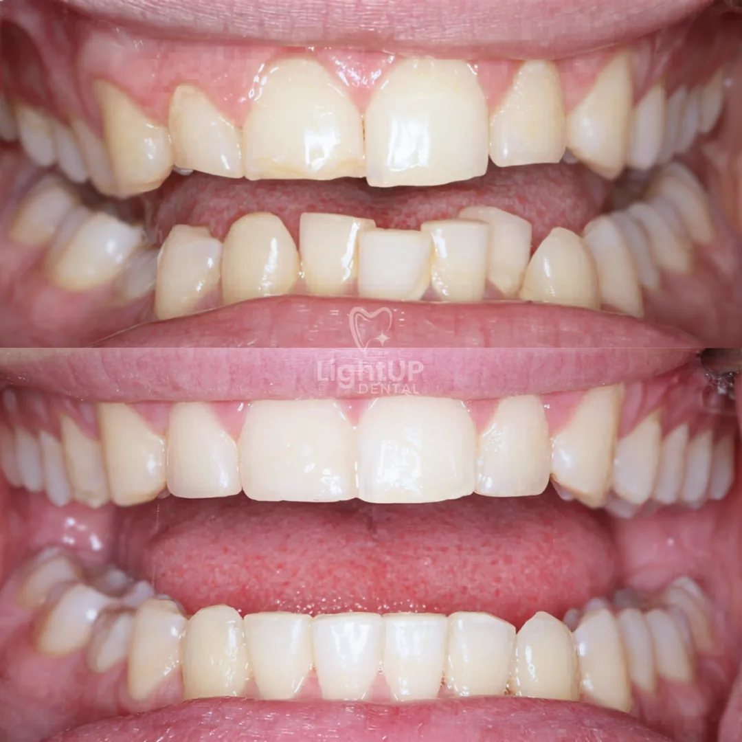 Clear Aligners
+ Edge Bonding (4 teeth) — before and after