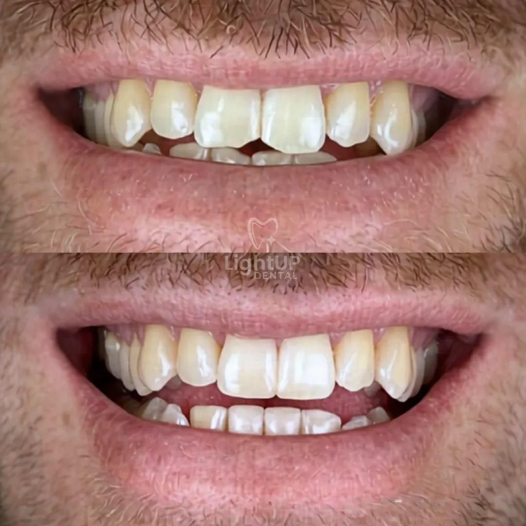 Edge Bonding (4 Teeth) — before and after